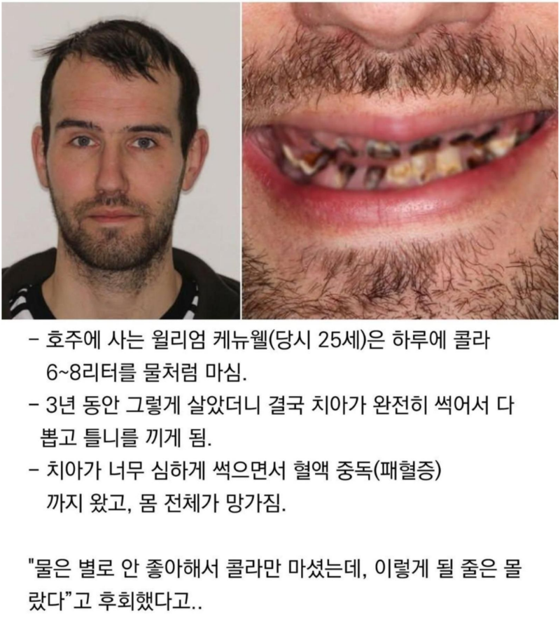 3년간 콜라먹은 남자 최후